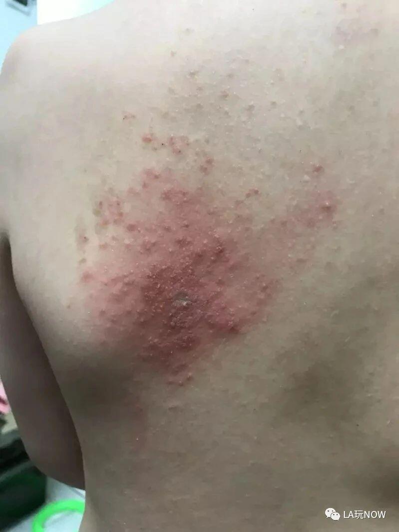 她一夜皮肤溃烂竟是它惹的祸 人在洛杉矶网lapeople Com