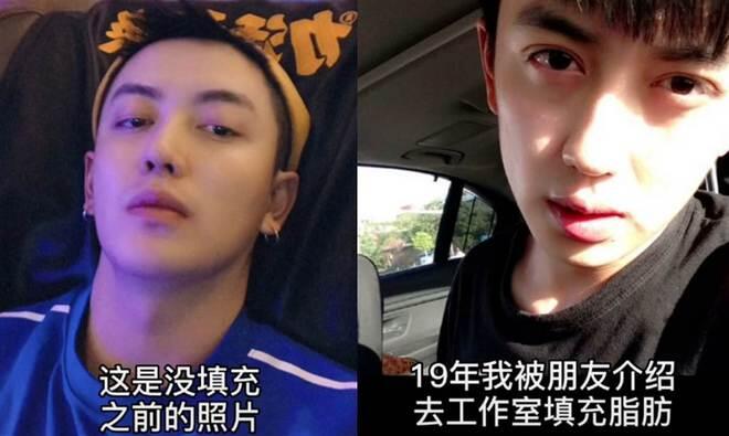 又一失败案例 网红整容变毁容 神隐两年才敢露面 人在洛杉矶网lapeople Com
